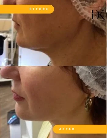 SMAS ліфтинг Ulthera System-668