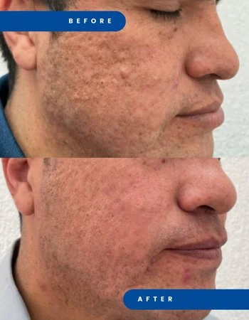 Полимолочная кислота Juvelook & Lenisna-293