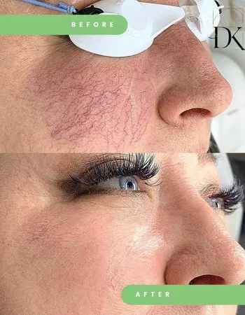 Лазерное удаление сосудов Cutera Laser Vascular-422