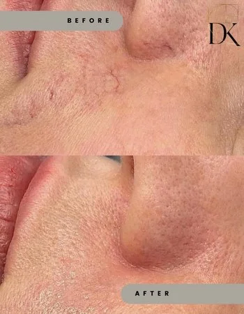 Фотоомоложение IPL Lumecca-344