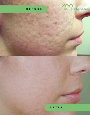 Лазерное омоложение Cutera Derma Genesis-482