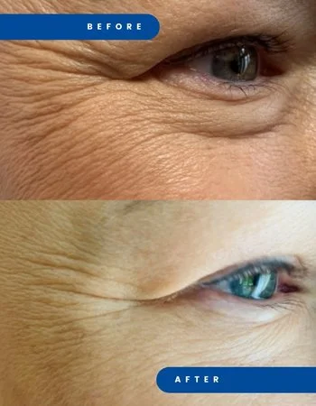 Полимолочная кислота Juvelook & Lenisna-296