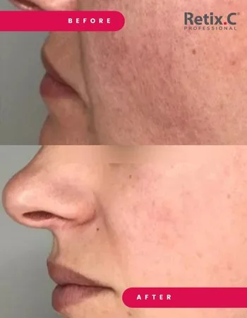 Химические пилинги Retix.C-473