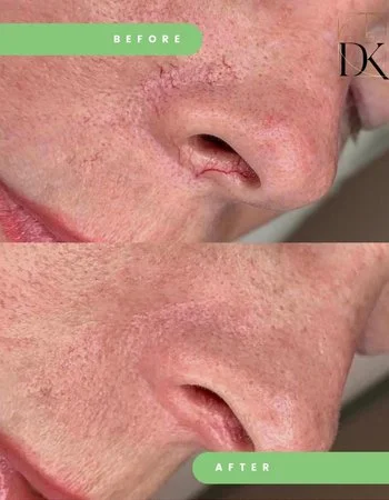 Лазерное удаление сосудов Cutera Laser Vascular-425