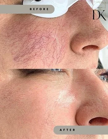 Фотоомоложение IPL Lumecca-347