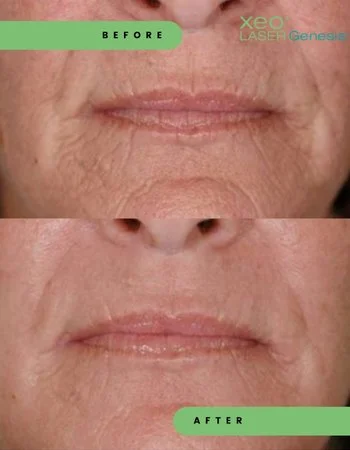 Лазерное омоложение Cutera Derma Genesis-485