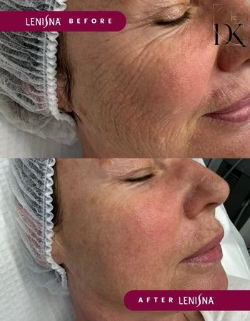 Полимолочная кислота Juvelook & Lenisna-500