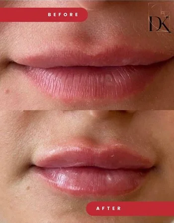 Контурная пластика губ Belotero-713