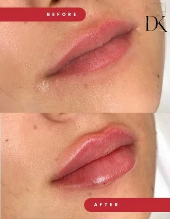 Контурная пластика губ Belotero-716