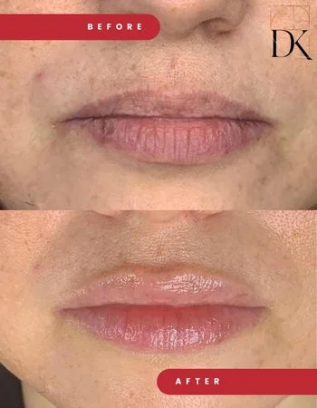 Контурная пластика губ Belotero-722