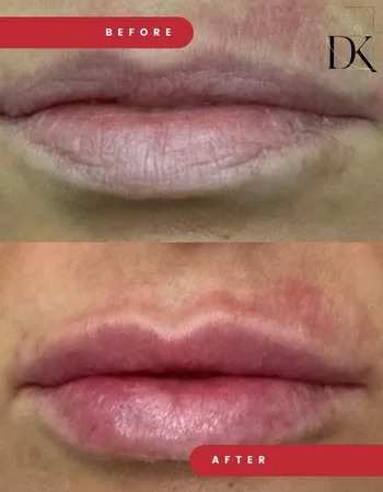 Контурная пластика губ Belotero-725