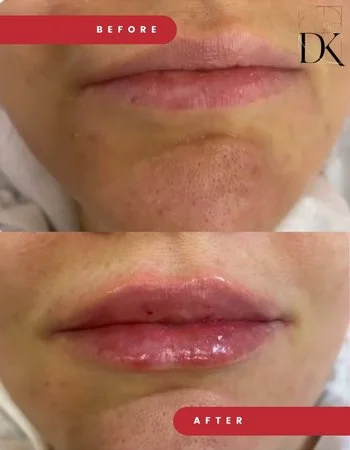 Контурная пластика губ Belotero-734