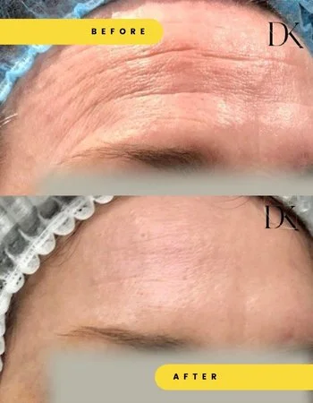 Бланшинг Белотеро-746