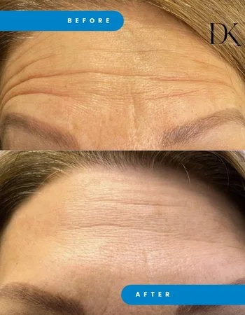 Ботулинотерапия Xeomin - Botox-761