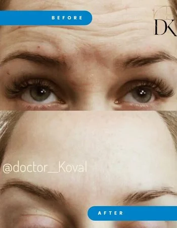Ботулинотерапия Xeomin - Botox-764