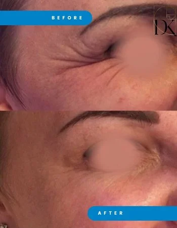 Ботулинотерапия Xeomin - Botox-773
