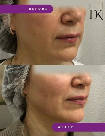 Контурная пластика лица Belotero-752