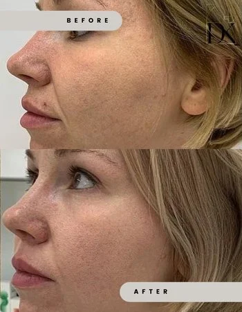 Микроигольчатый RF-Лифтинг Morpheus-8-631