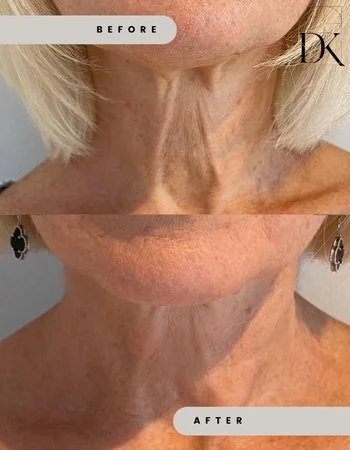 Микроигольчатый RF-Лифтинг Morpheus-8-643