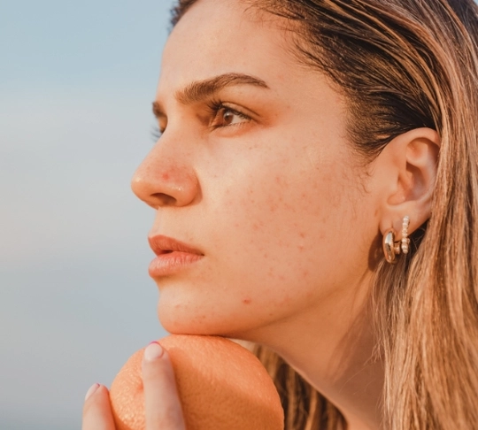 Лечение постакне-126