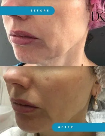 Векторный лифтинг Radiesse-680