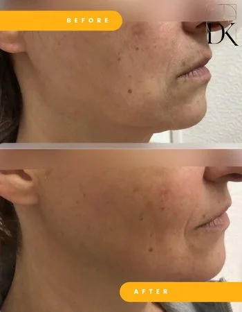 SMAS лифтинг Ulthera System-656