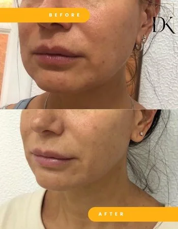 SMAS лифтинг Ulthera System-665